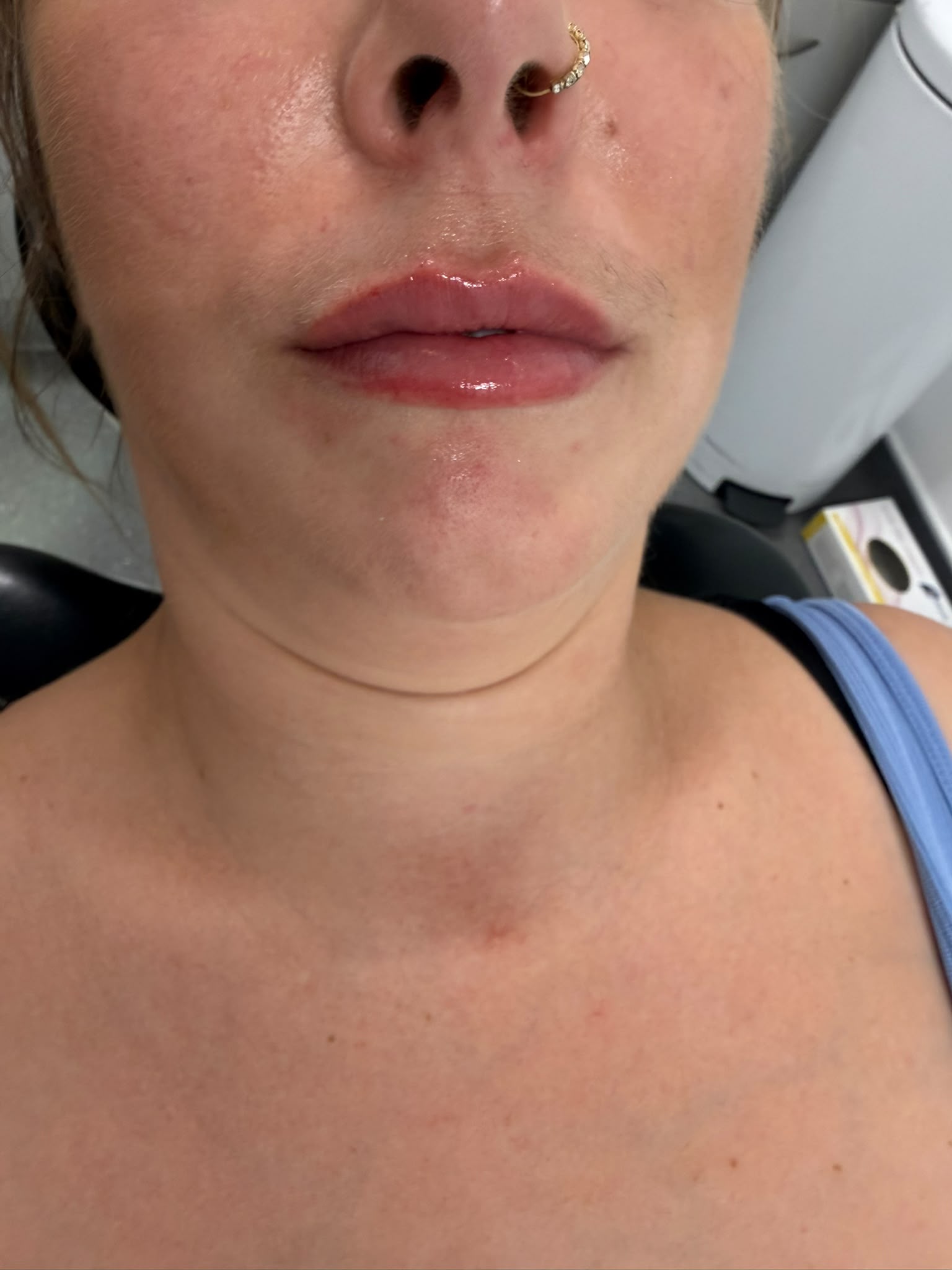 After - Natural lip enhancement with defined vermilion border and balanced cupid’s bow — subtle volume, beautiful proportion