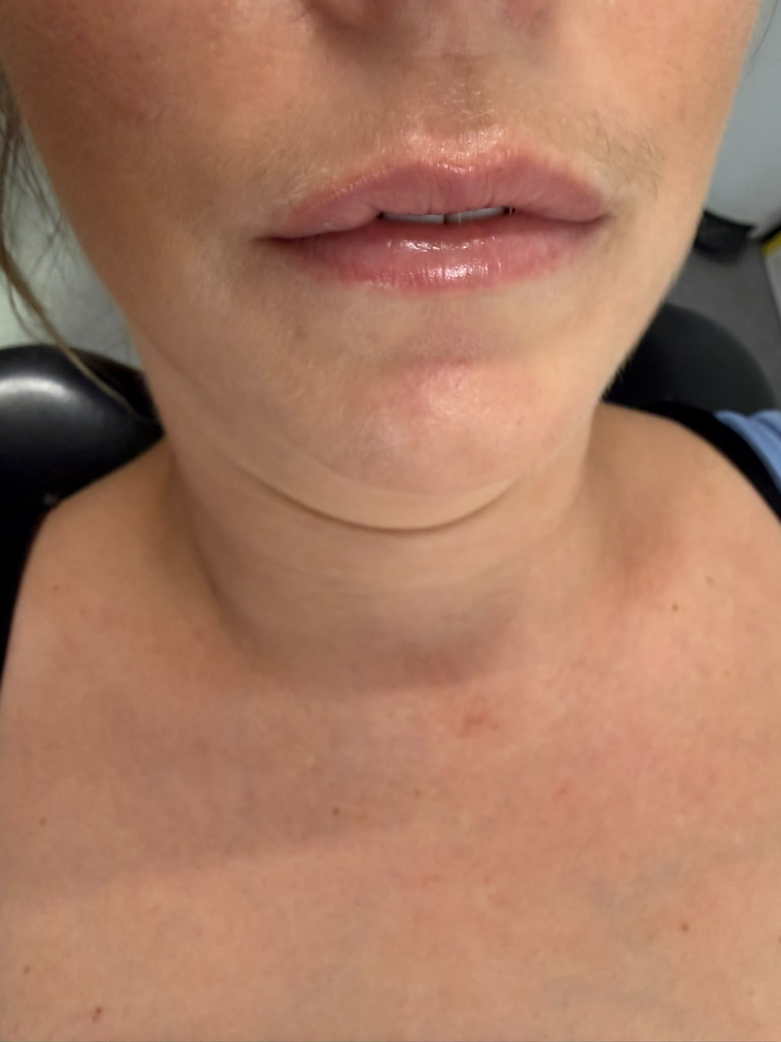 Before - Natural lip enhancement with defined vermilion border and balanced cupid’s bow — subtle volume, beautiful proportion