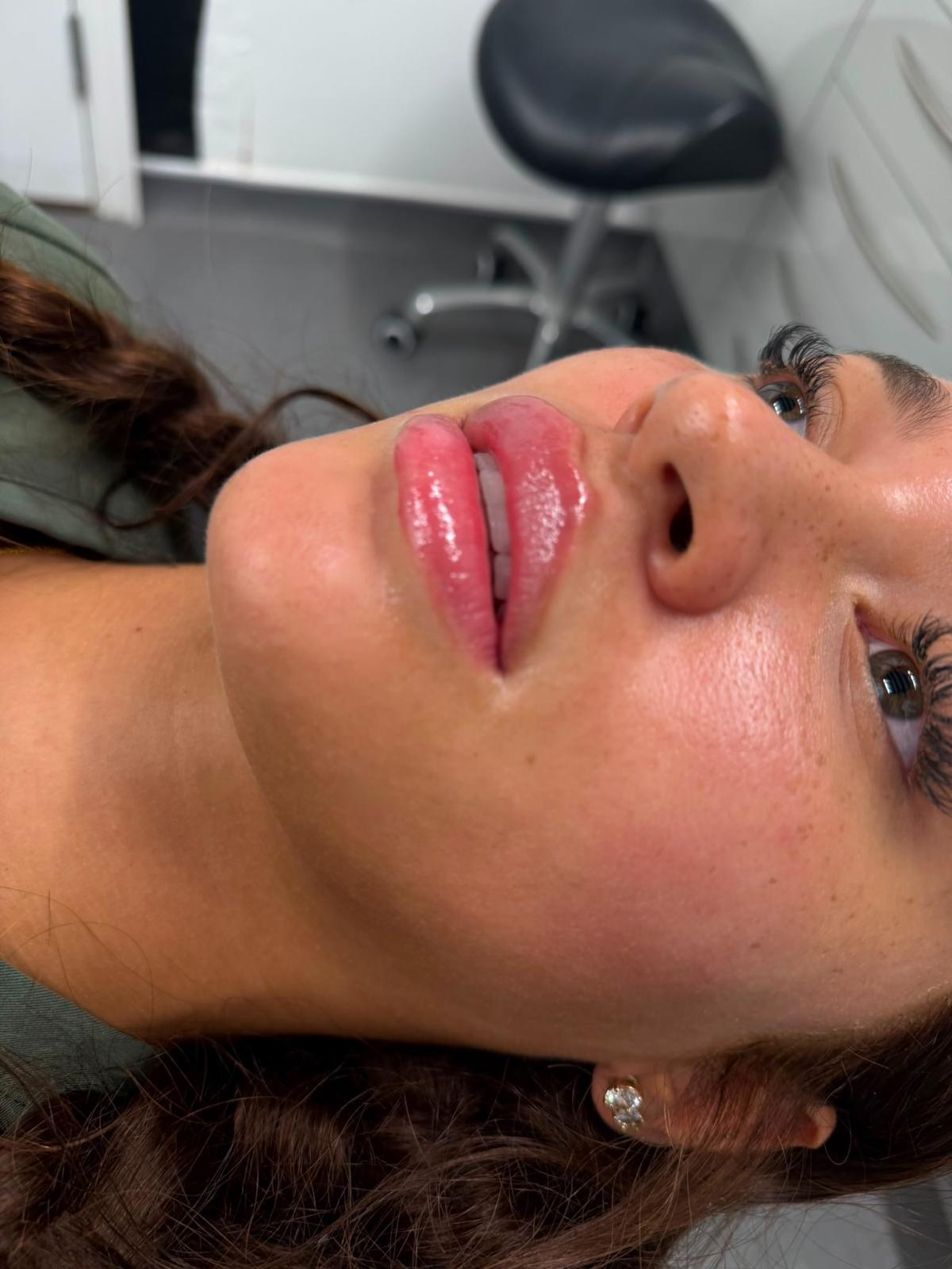 After - Cupid’s bow definition and lip border enhancement — elegant contouring with natural-looking fullness