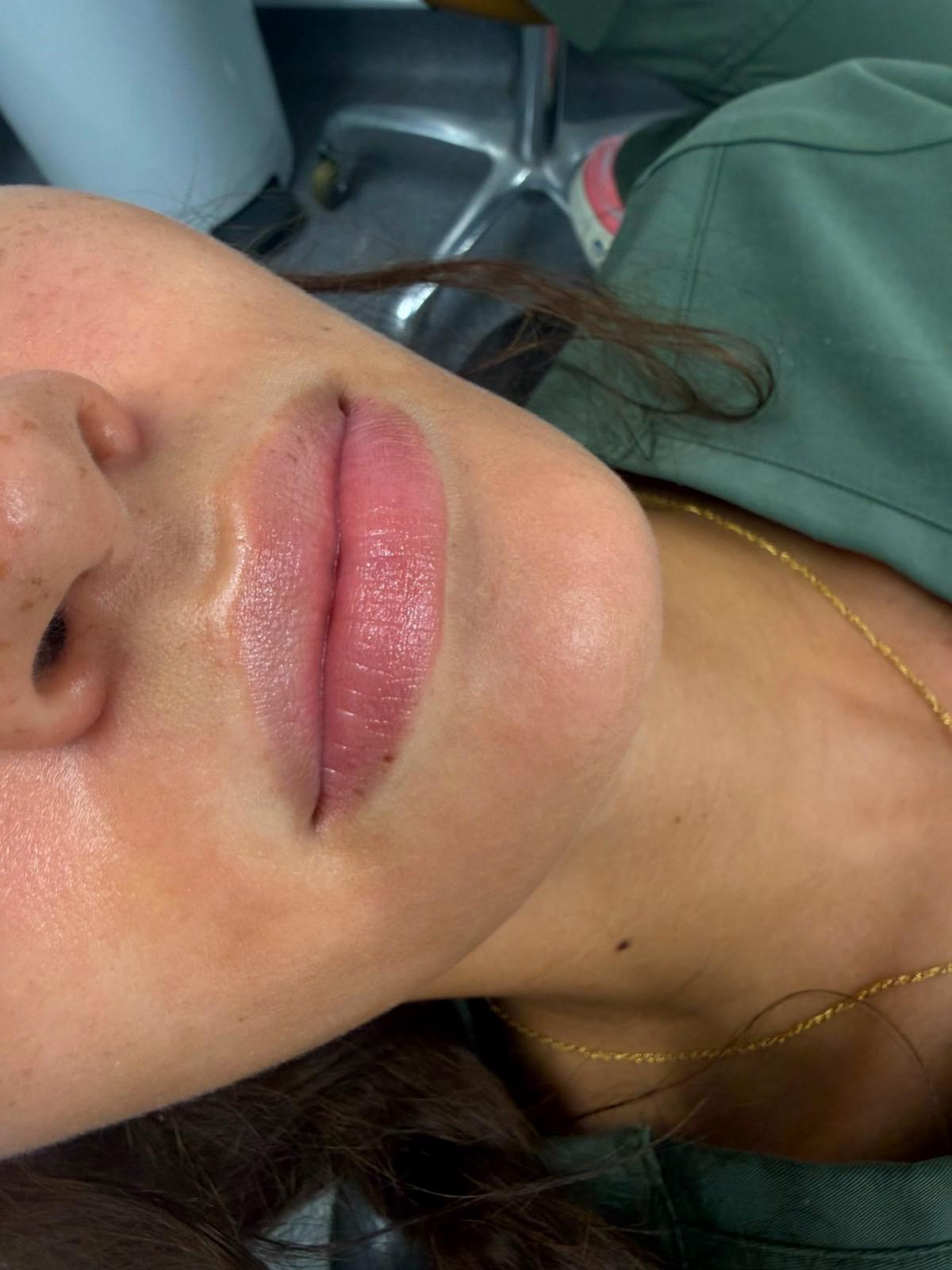 Before - Cupid’s bow definition and lip border enhancement — elegant contouring with natural-looking fullness